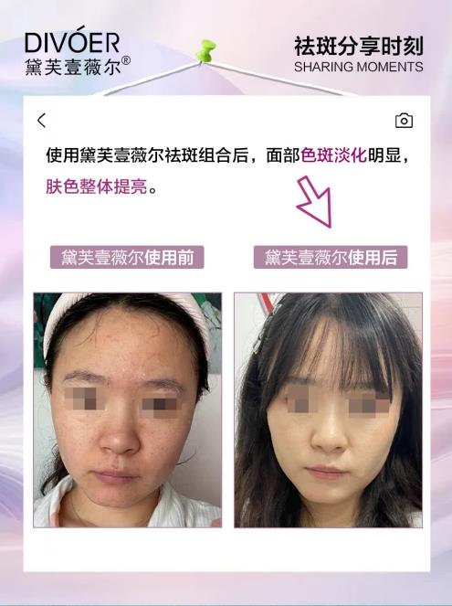 黛芙壹薇爾(divoer)祛斑效果怎么樣?不愧是國家認證的祛斑組合