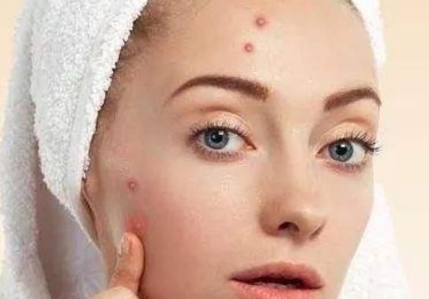青春痘過多讓人很煩惱 推薦4種食物幫助去除青春痘