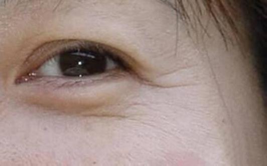 如何去眼袋有效 為你消除眼袋肌膚問(wèn)題