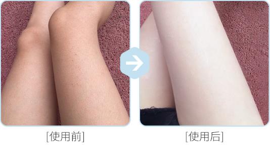 腿上雞皮膚怎么消除最有效 三種簡單又實用的方法