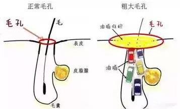 北京伊美爾愛康醫院:超微小氣泡是什么