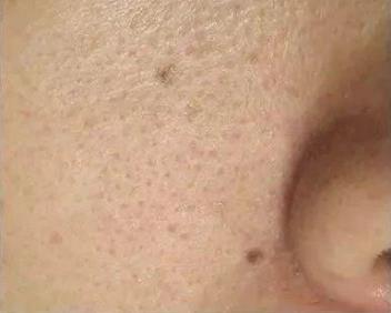 北京伊美爾愛康醫院:超微小氣泡是什么