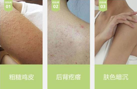 治雞皮膚的藥膏叫什么 有多年護(hù)膚管理的老師這么說(shuō)