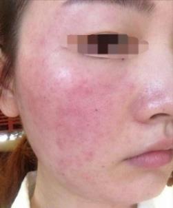 激素臉怎樣治療?激素臉正確的治療方法