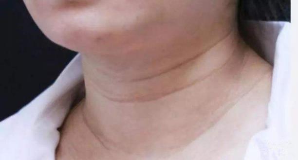 重塑天鵝頸,守住優雅的最后一道防線