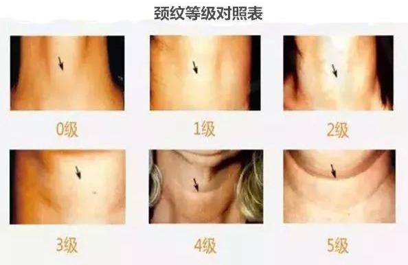重塑天鵝頸,守住優雅的最后一道防線