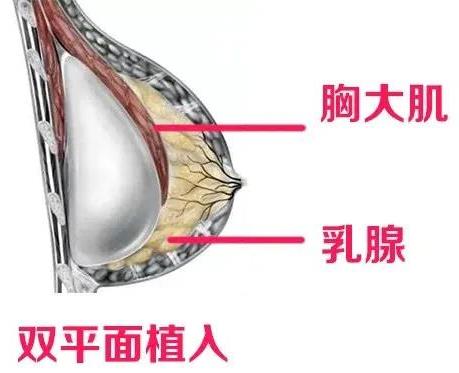 杭州美萊栗勇教授科普假體隆胸假體,究竟要怎么選擇合適自己的呢?