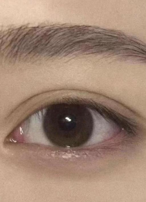 雙眼皮埋線不能吃什么?雙眼皮埋線需要注意什么