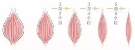 伊美爾愛康醫院自體脂肪填充效果好不好?