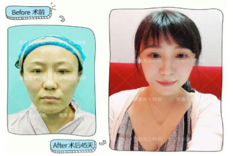 首璽麗格悅升線:意大利進口悅升線,維持時間可以長達2年之久