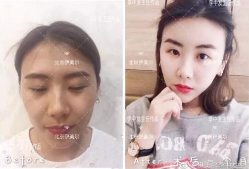 伊美爾愛康醫院自體脂肪填充效果好不好?