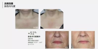 菲洛嘉價格貴不貴?北京伊美爾紫竹幫你恢復水潤美白