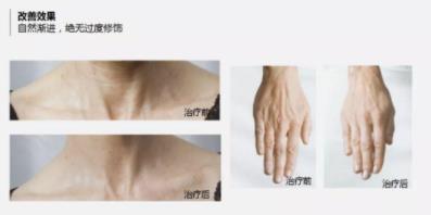 菲洛嘉價格貴不貴?北京伊美爾紫竹幫你恢復水潤美白