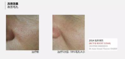 菲洛嘉價格貴不貴?北京伊美爾紫竹幫你恢復水潤美白