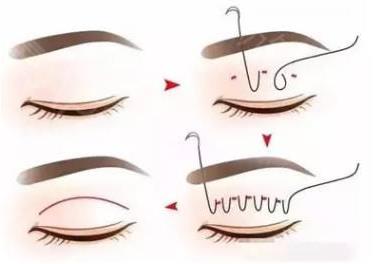 埋線雙眼皮適合所有人嗎 埋線雙眼皮的優(yōu)點(diǎn) 術(shù)后多久能化妝