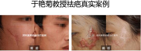 鄭州美萊整形靠不靠譜 科學(xué)祛疤祛胎記 效果見證實(shí)力
