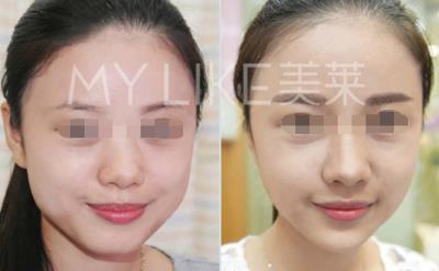 鄭州美萊整形靠譜么 口碑致勝 專業技術為你塑造美麗