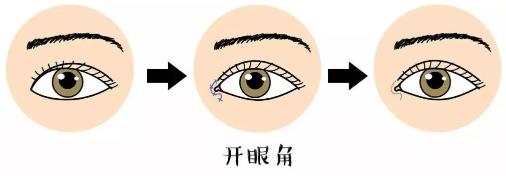 鄭州美萊整形靠譜么 重塑優(yōu)美弧線靈韻精雕大眼