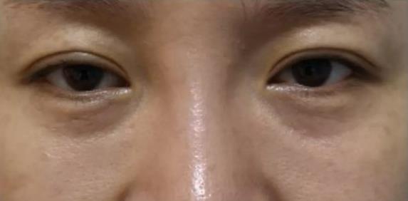 廈門薇格醫院做眼部整形專業嗎 讓您更美一點