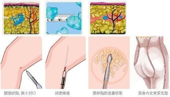 南京韓辰吸脂術 力求整形美無痕