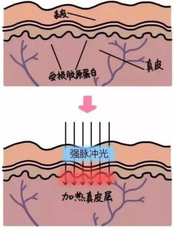 北京伊美爾紫竹醫院:光子嫩膚多久做一次