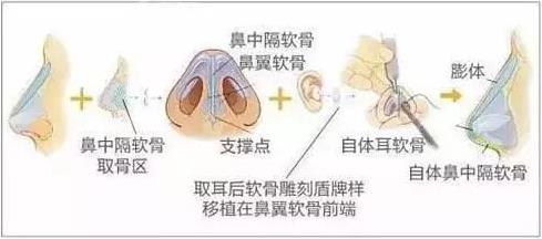 北京伊美爾健翔醫院:隆鼻的害處