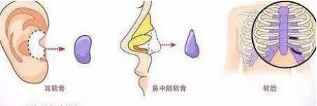 北京伊美爾健翔醫院:隆鼻的害處