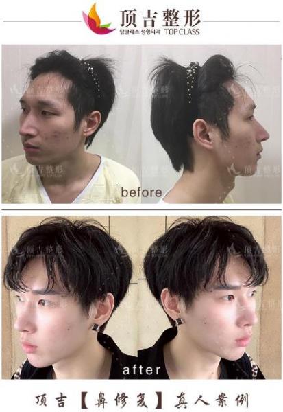 武漢頂吉鼻修復效果怎么樣 純韓專家重塑自然美鼻