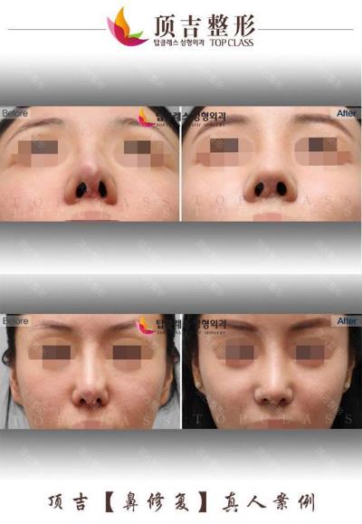 武漢頂吉鼻修復效果怎么樣 純韓專家重塑自然美鼻