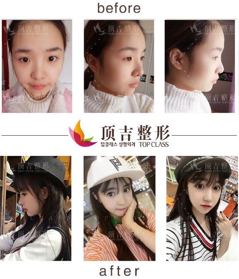 武漢頂吉鼻整形如何 頂吉名品鼻無(wú)懼揉捏 自然天成