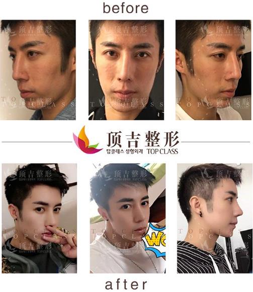 武漢頂吉鼻整形如何 頂吉名品鼻無(wú)懼揉捏 自然天成