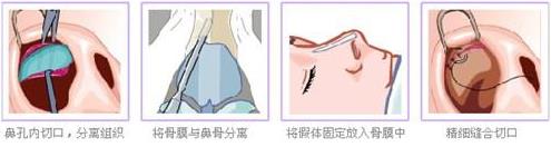 福州米蘭整形如何 為你訂制個性化的塑美方案