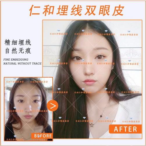 蘭州仁和整形埋線雙眼皮好不好 品質(zhì)口碑讓你安全變美