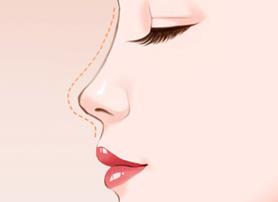 福州格萊美醫院隆鼻:鐘德成院長解析3+3立挺半肋鼻綜合