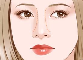 福州格萊美醫院隆鼻:鐘德成院長解析3+3立挺半肋鼻綜合