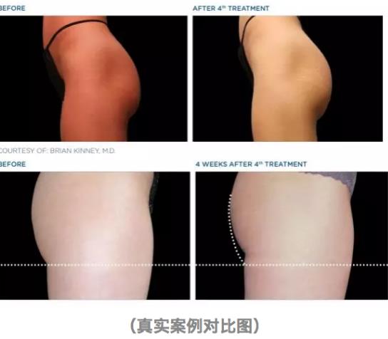 BTL公司Emsculpt美修斯磁波塑肌,是如何做到增肌又減脂的