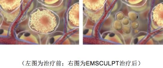 BTL公司Emsculpt美修斯磁波塑肌,是如何做到增肌又減脂的