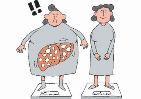 脂肪肝的癥狀有哪些?如何預防脂肪肝