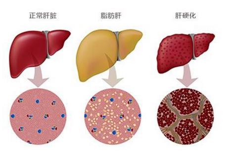 脂肪肝的癥狀有哪些?如何預防脂肪肝