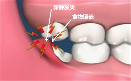 牙菌斑以及食物殘渣等容易對拔智齒的創口造成感染。