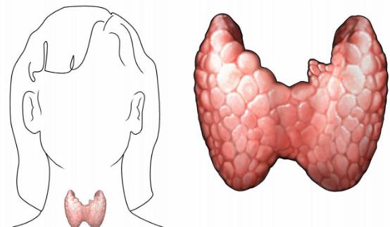 甲狀腺結節(jié)是什么?患甲狀腺結節(jié)有哪些癥狀?