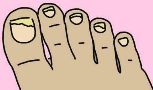 哪些人容易患灰指甲?灰指甲的日常護理有哪些?