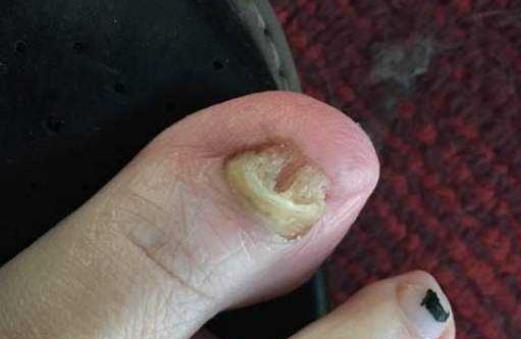灰指甲有哪些分類?患了灰指甲可以做哪些檢查?