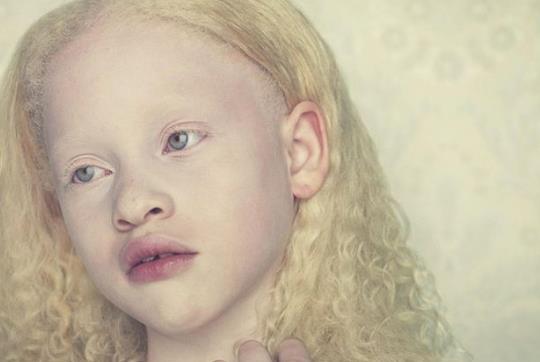 白化病和哪些疾病相似?白化病和白癜風有哪些區別?