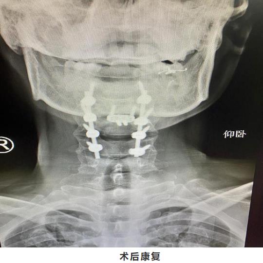 南川宏仁一醫院:一位高位脊髓損傷伴截癱患者的“重生”之路