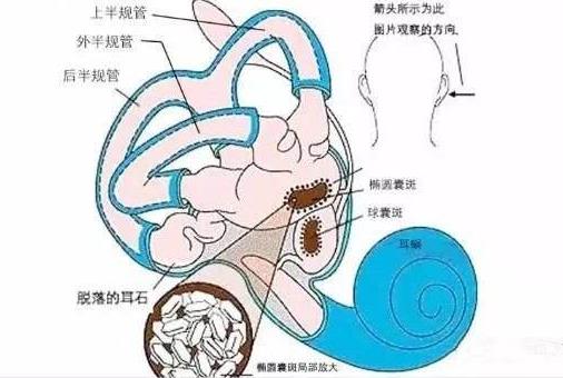 耳朵里有石頭還頭暈,成都民生耳鼻喉醫(yī)院提醒你:這是耳石癥!
