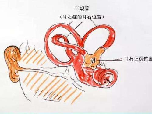 耳朵里有石頭還頭暈,成都民生耳鼻喉醫(yī)院提醒你:這是耳石癥!