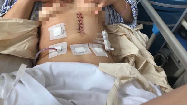 重慶南川宏仁一醫院:普外科完成首例腹腔鏡輔助胃癌根治術