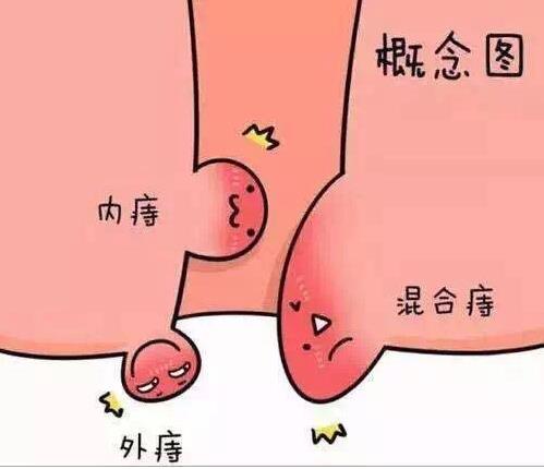 痔瘡出血了該怎么辦?痔瘡用什么可以治好?
