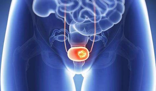 膀胱癌的疾病分類有哪些?膀胱癌的治療方法有哪些?